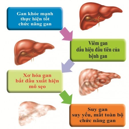 Viêm gan B là sát thủ gây ung thư gan
